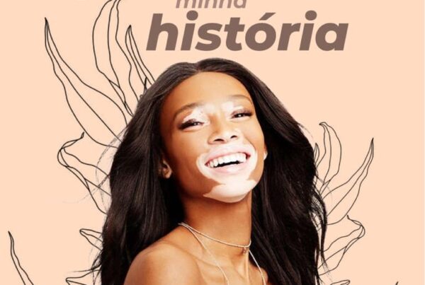 Vitiligo