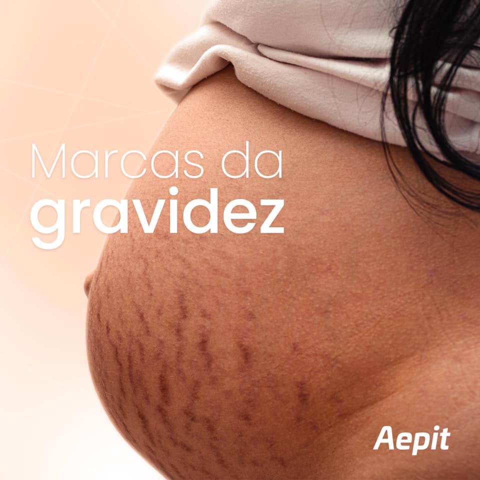 Estrias na gravidez
